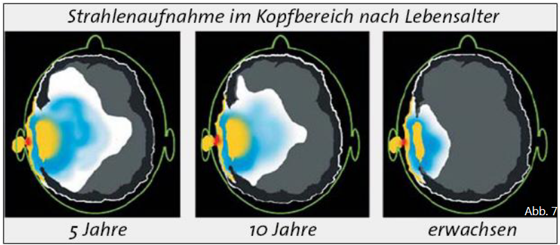 Strahlenaufnahme am Kopf von Kindern